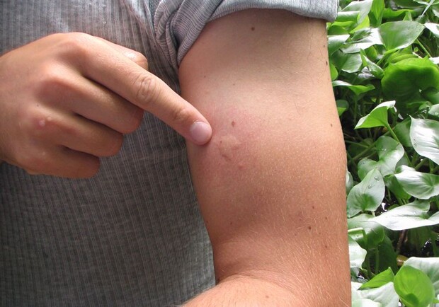 Asian mosquito bite swelling