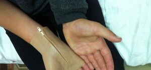 В Киеве впервые протезировали раненого ребенка из Донбасса